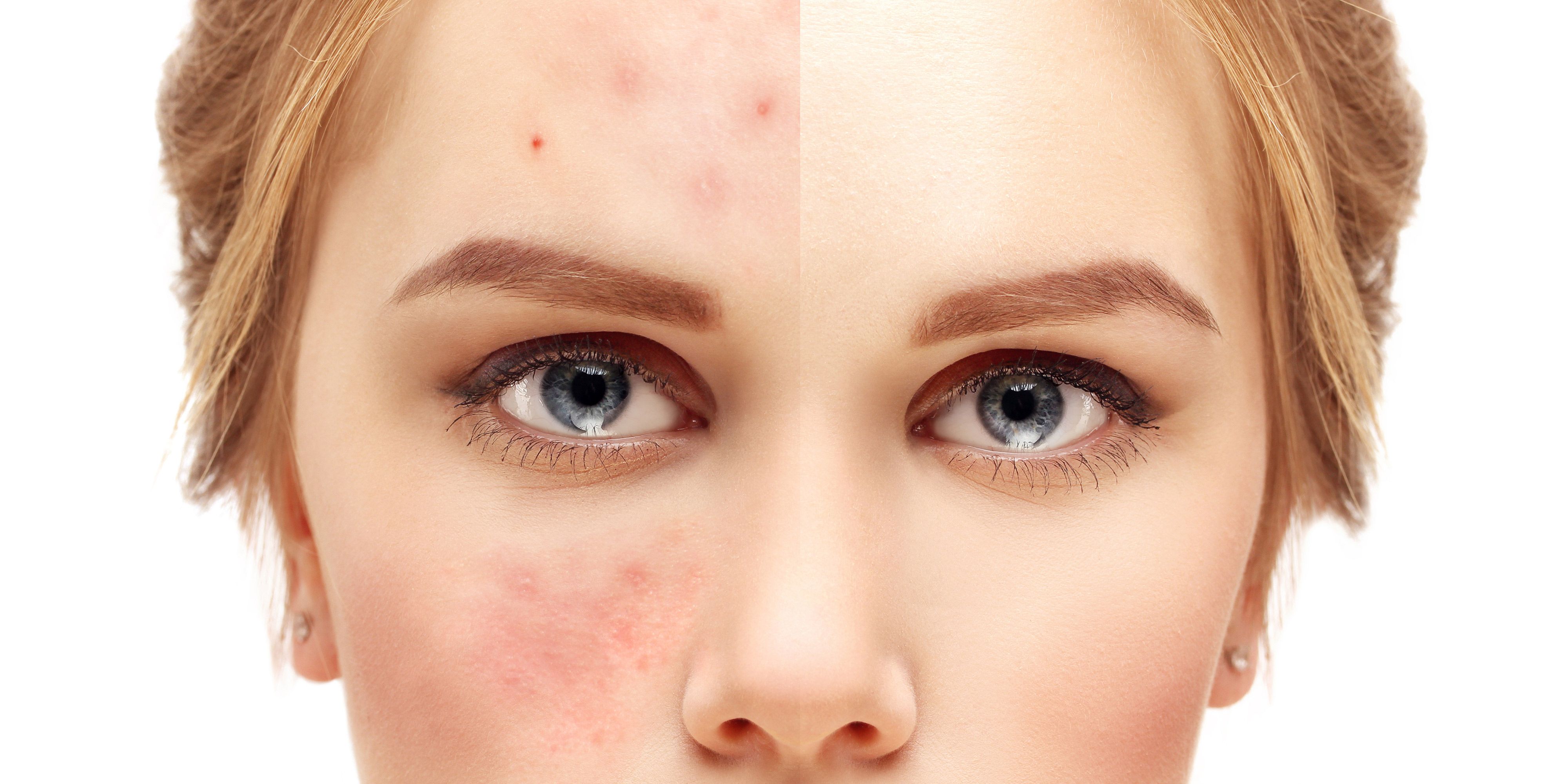 Watch 7 Acne Myths That Are Keeping You from Having Clear Skin video Watch 7 Acne Myths That Are Keeping You from Having Clear Skin video