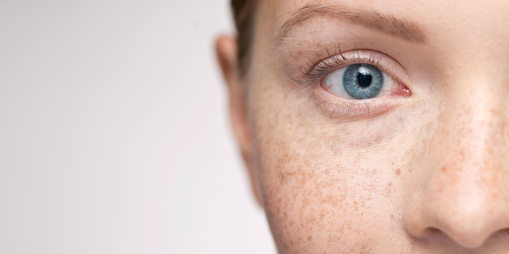 Freckles Melasma And Hyperpigmentation