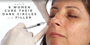 Does filler cure dark circles?