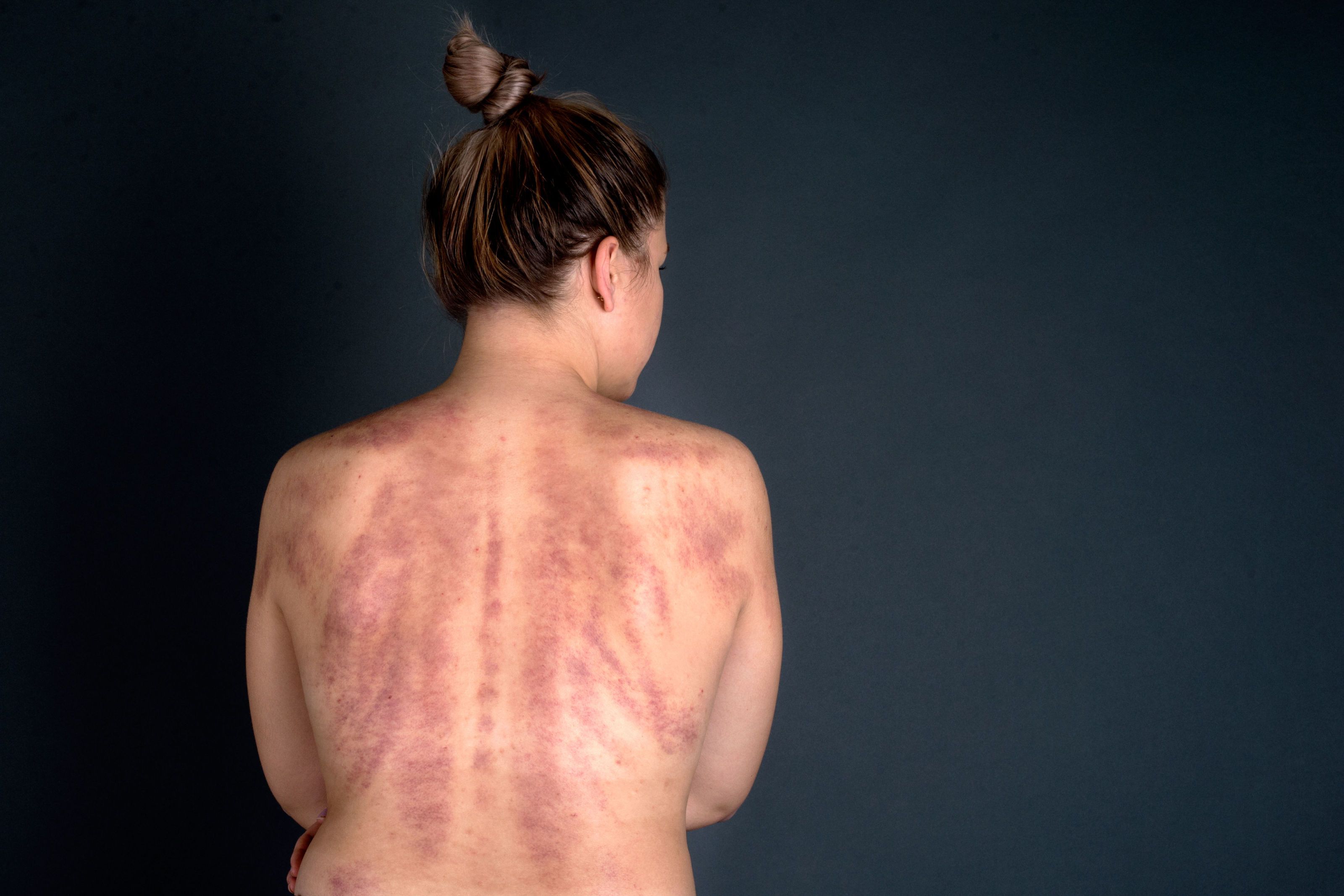 The Shockingly Grotesque, Yet Incredible Results of Gua Sha ...