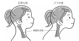 その頭痛 腰痛 肌荒れは スマホ首 が原因かも 改善方法と予防策を専門家が解説 その頭痛 腰痛 肌荒れは スマホ首 が原因かも 改善方法と予防策を専門家が解説