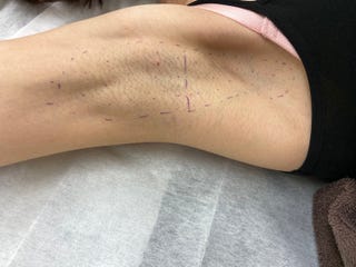 脇汗の悩みから解放 脇ボトックスの効果を体験レポート 脇汗の悩みから解放 脇ボトックスの効果を体験レポート