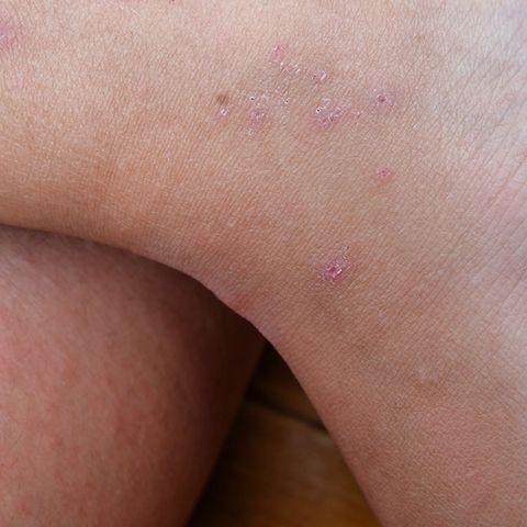 types of rashes