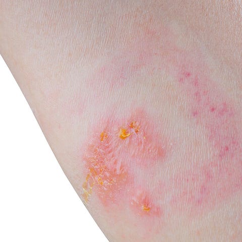 image types of rashes