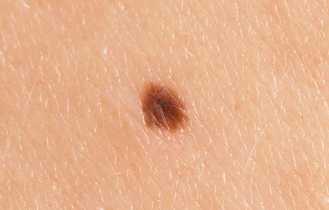 Signs of Skin Cancer: new mole