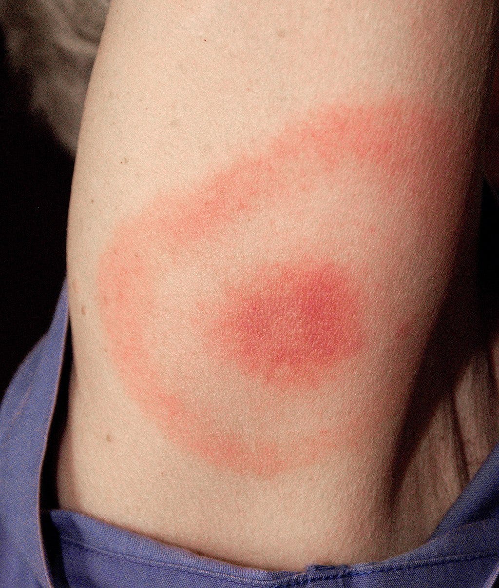 causes of rash purple