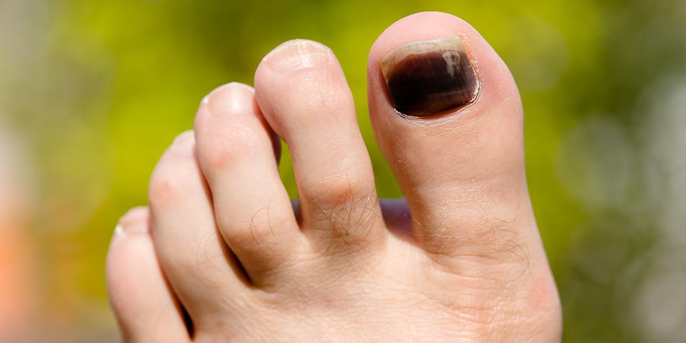 5 Causes of Black Toenails—and How to ID the Harmless From the Harmful ...