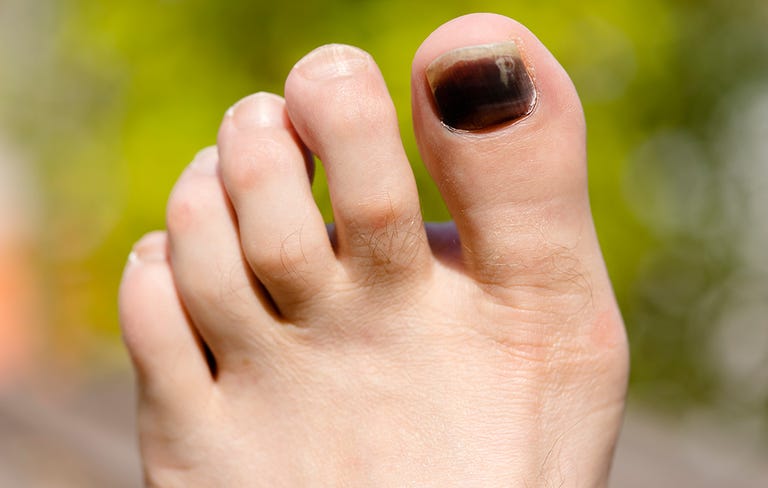 there-s-this-black-line-across-my-toenail-what-does-it-mean-r-medical