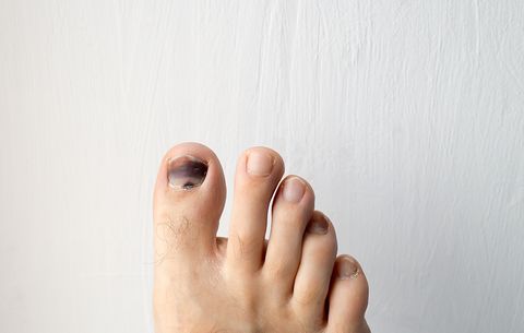 blackened toenail