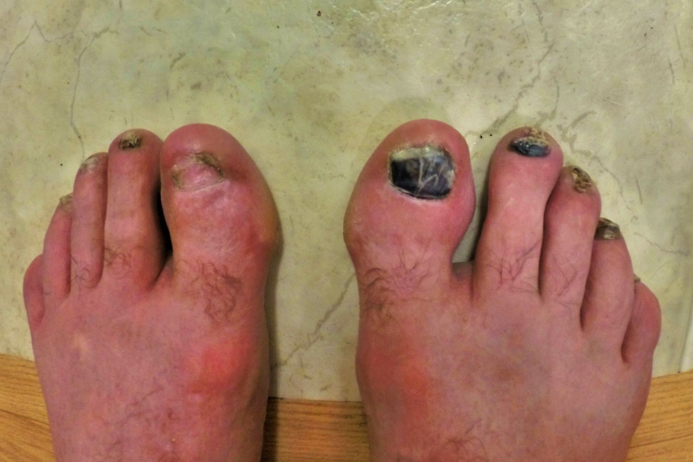 The Grossest Runners Feet You Ve Ever Seen Take a picture of your foot and ...