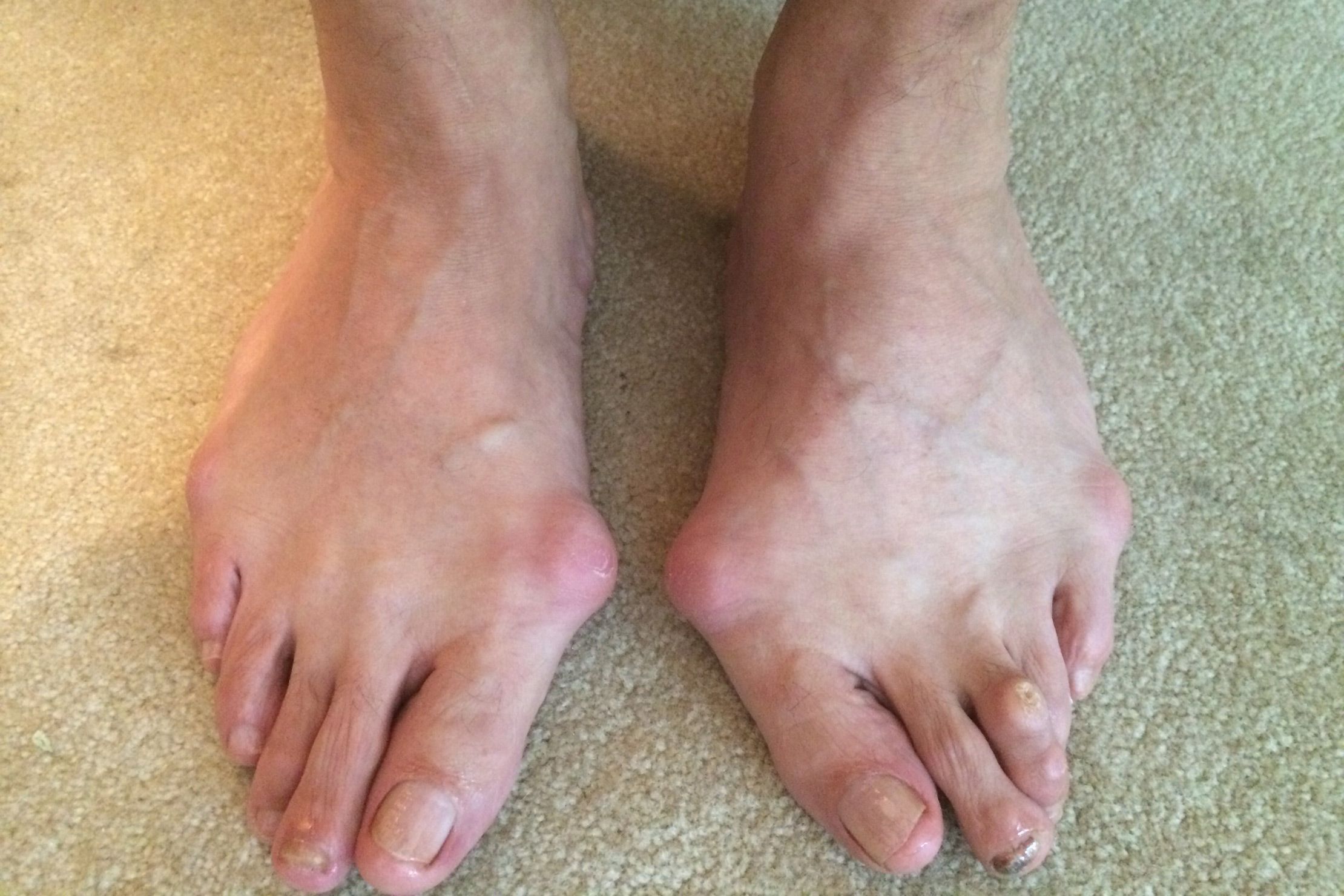 That Hide Your Feet toe-curling truths about ugly feet The Grossest Runners...