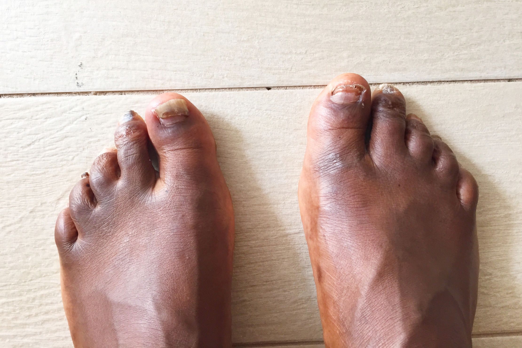 black crusty toes