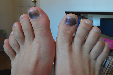 These Are the Ugliest Runners' Feet You've Ever Seen | Runner's World