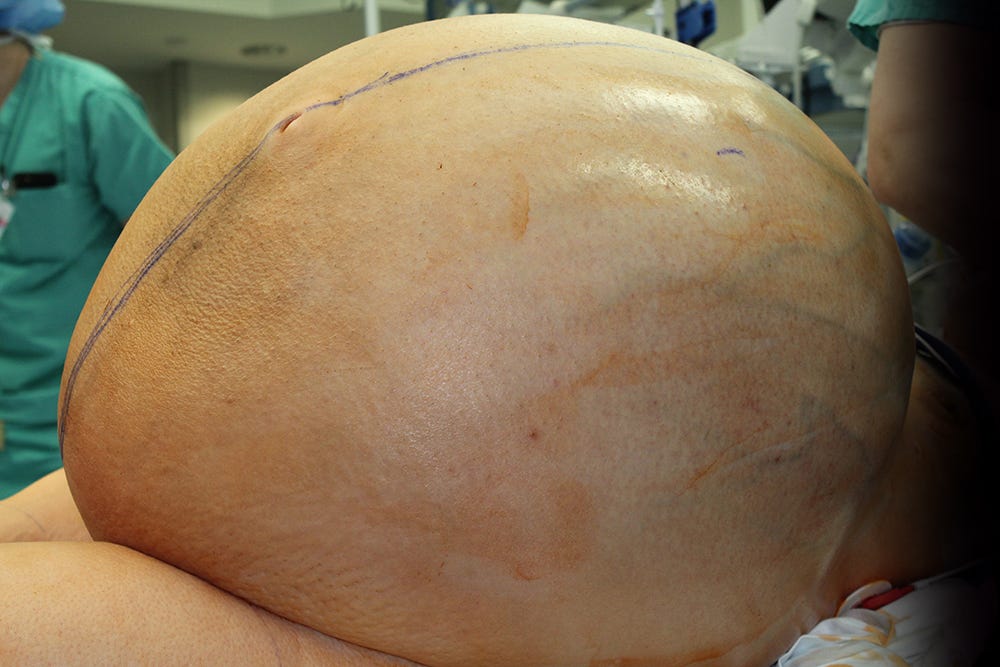 All The Photos Of The 132 Pound Ovarian Tumor Removed From Connecticut Womans Abdomen 2259