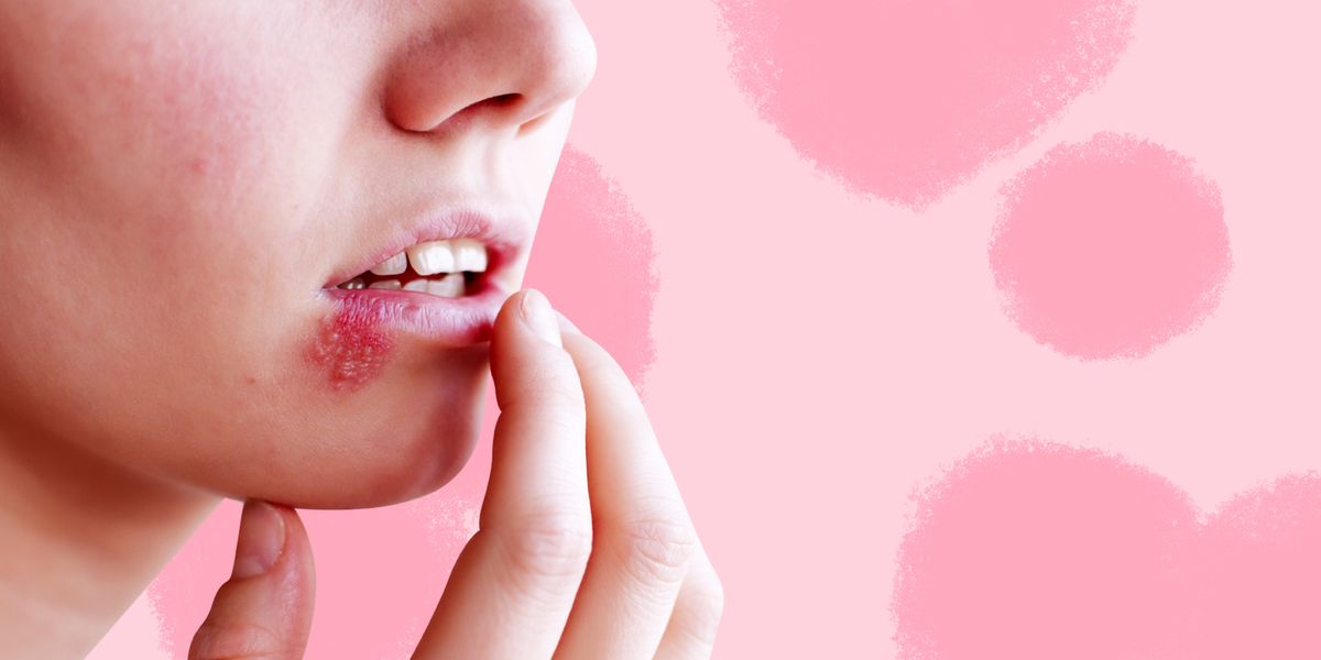 Are Cold Sores A Sign Of Herpes What Is Herpes And What Are The Symptoms