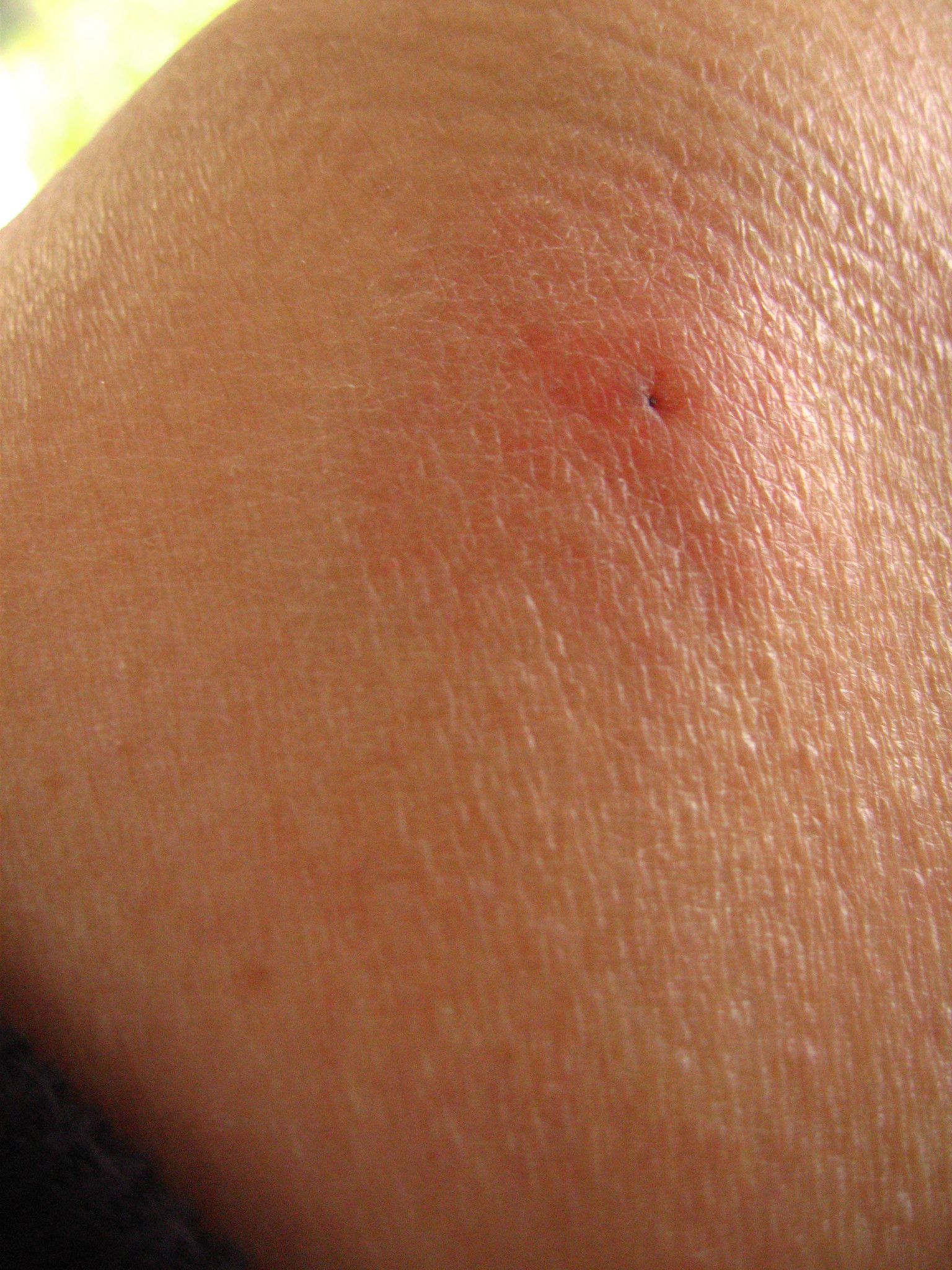 early stage tick bite