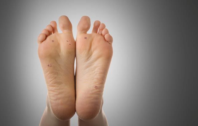 papilloma on soles of feet