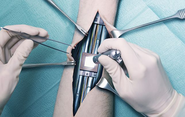 Implantul de penis care salvează vieți și e disponibil în trei dimensiuni