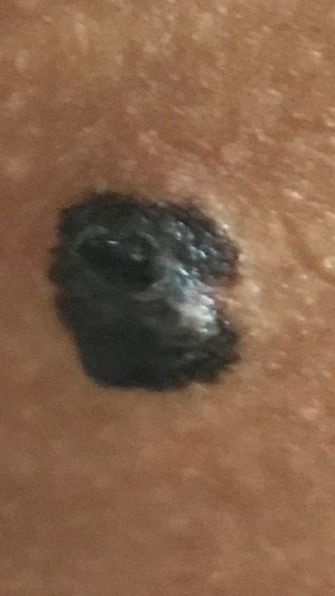 smith's cancerous mole