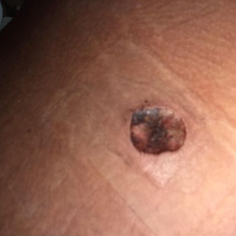 removal of mole