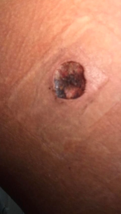 removal of mole