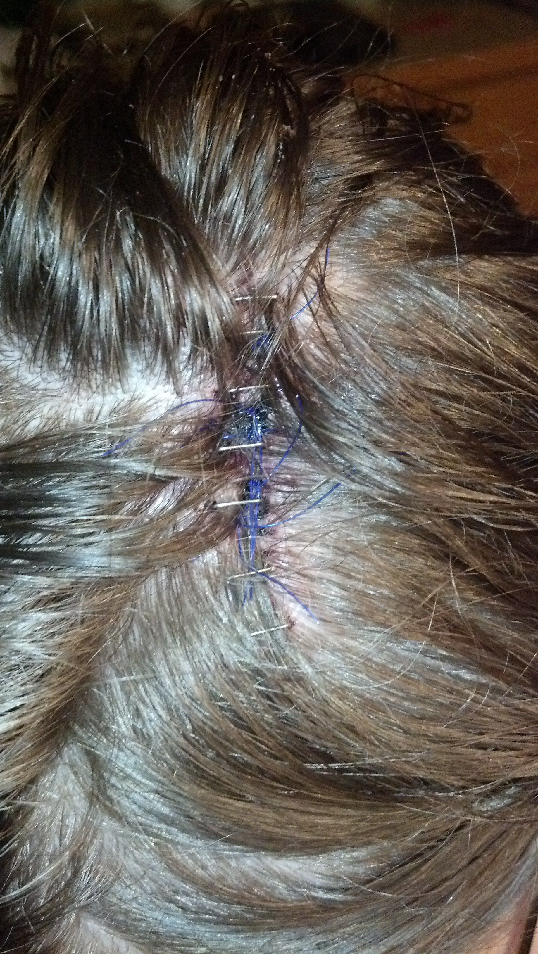 this-woman-had-no-idea-she-had-melanoma-on-her-scalp-until-her-hair