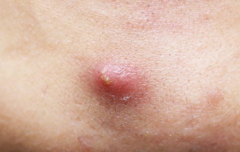 image zit wont go away