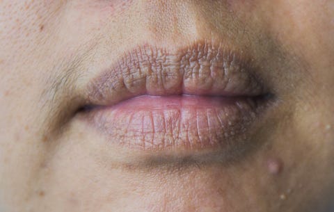 image chapped lips