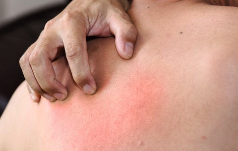 image dry skin