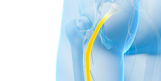 Sciatica Guide: Causes, Symptoms and Treatment Options