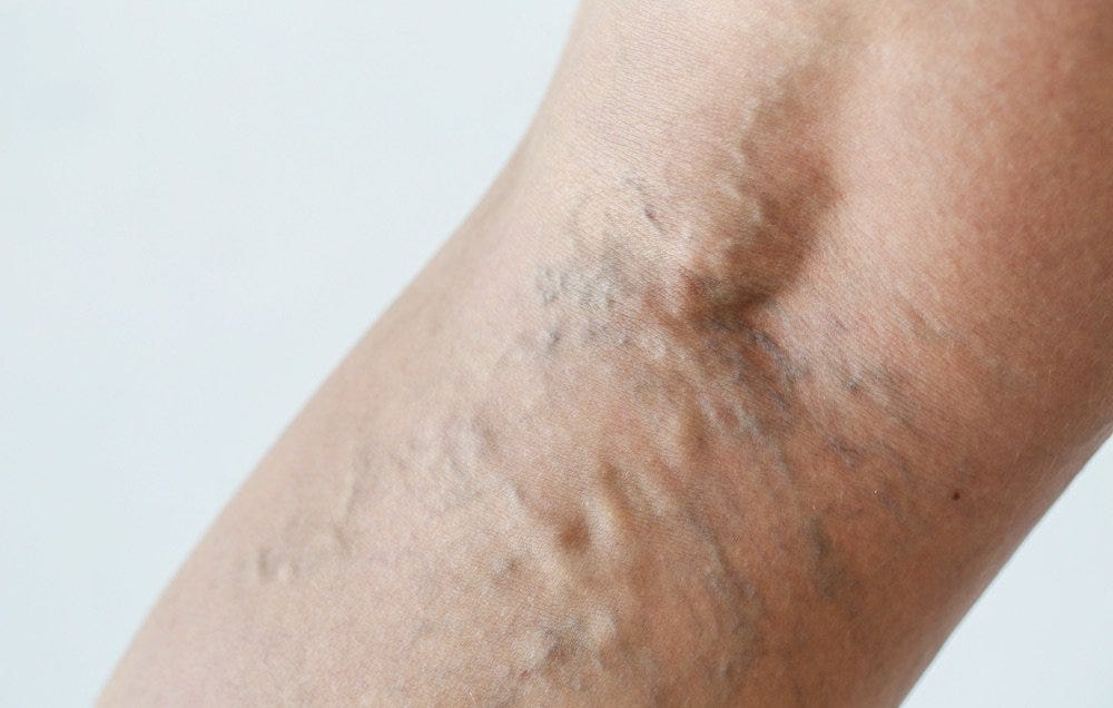 boli venoase