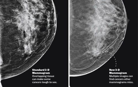 Meet The New Mammogram: A 3-D Medical Breakthrough | Prevention