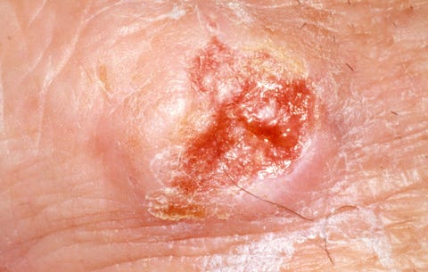 7 Skin Cancer Symptoms Besides New Moles - Signs of Skin Cancer