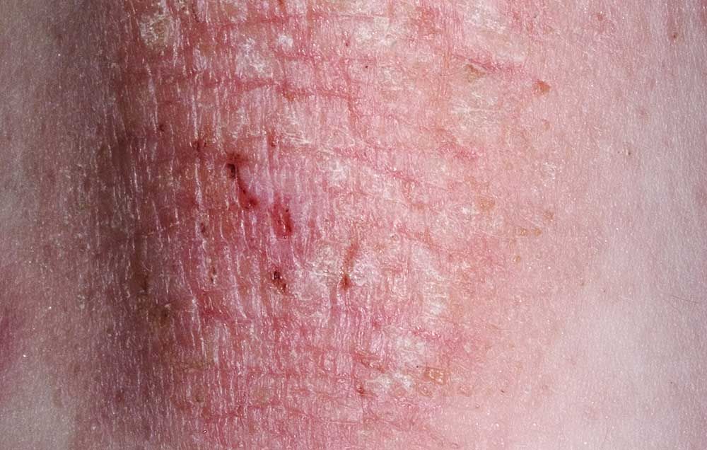 6 Things Your Eczema Is Trying To Tell You | Prevention