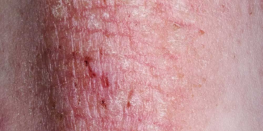 6 Things Your Eczema Is Trying To Tell You Prevention 1919