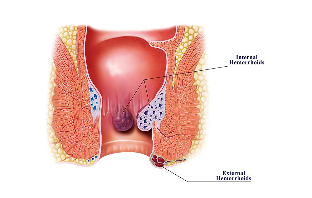 11 Things Every Woman Needs To Know About Hemorrhoids Prevention