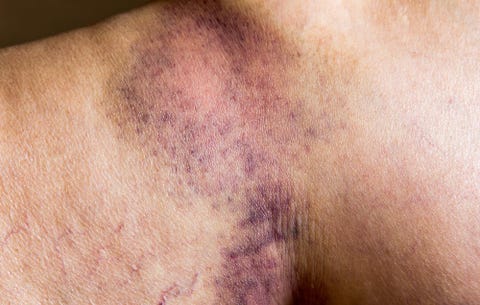 image bruise