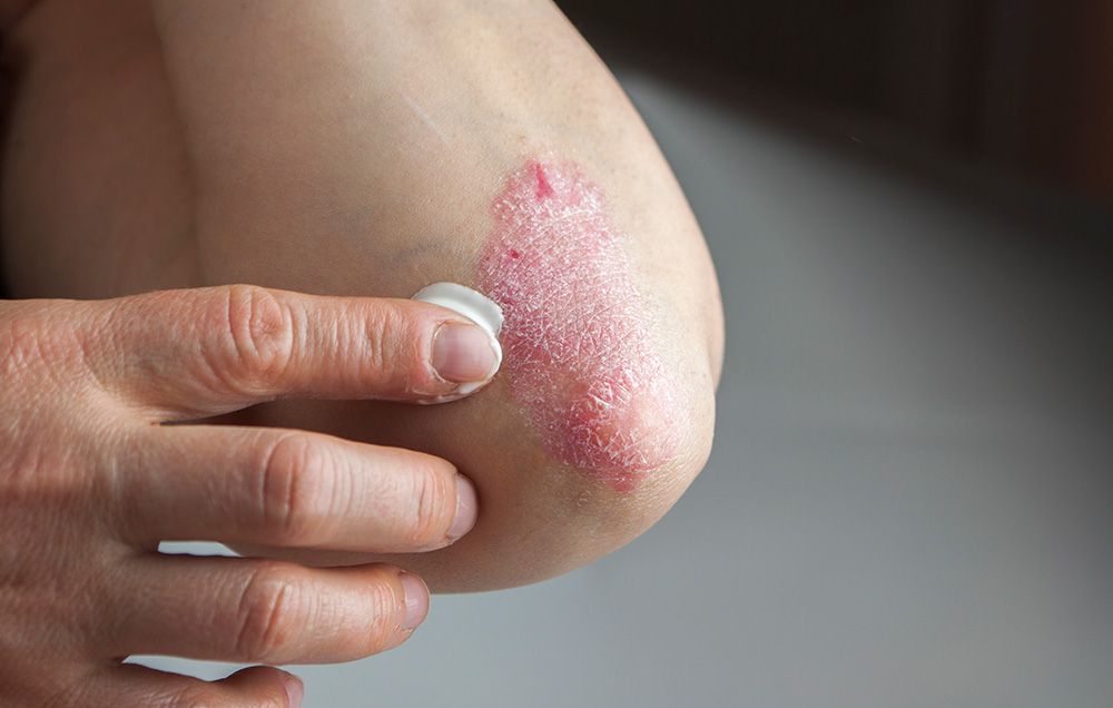 eczema treatment without hydrocortisone