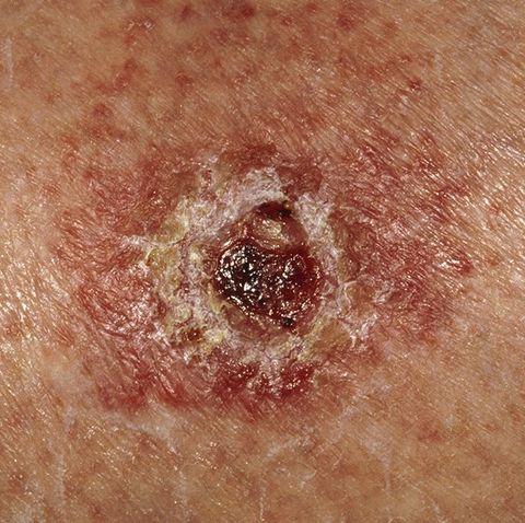 open sore skin cancer symptom