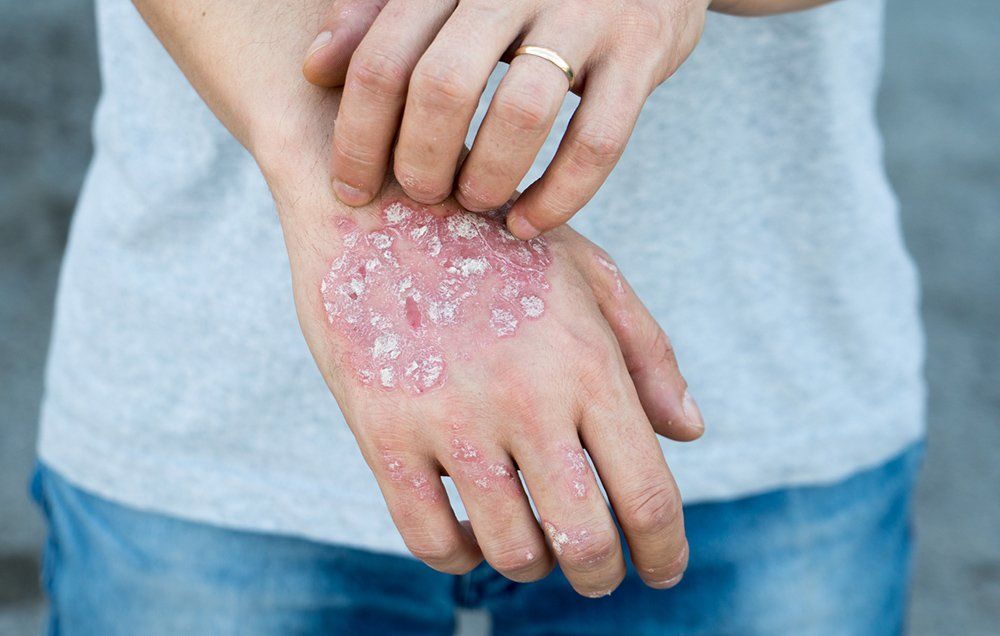 root causes psoriasis symptoms)