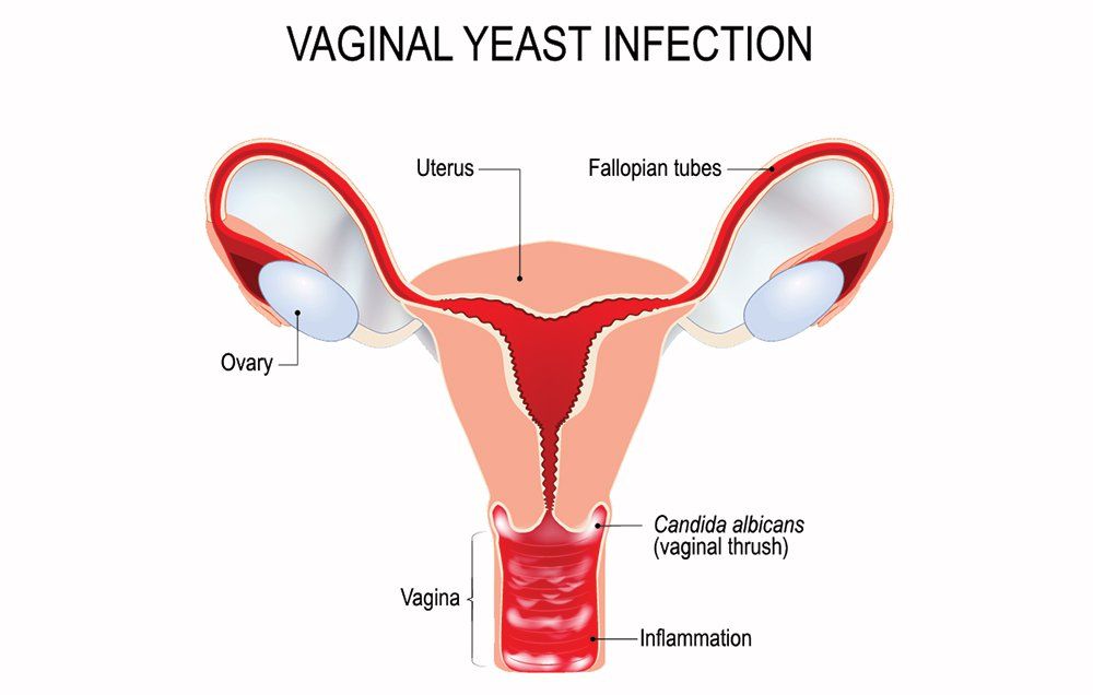 signs of candidiasis