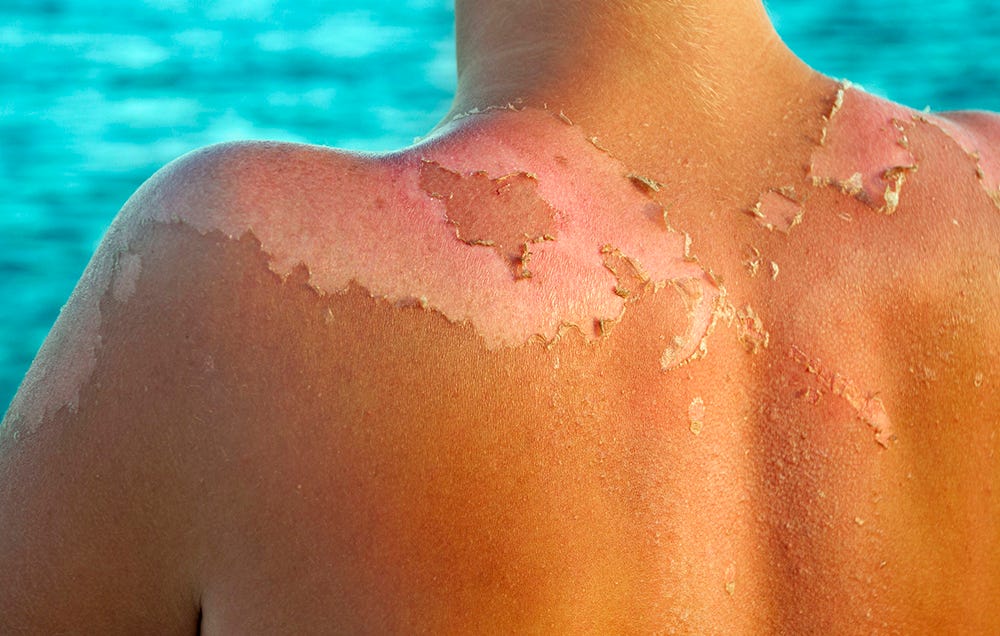 How To Get Rid Of Sunburn Fast Without Aloe