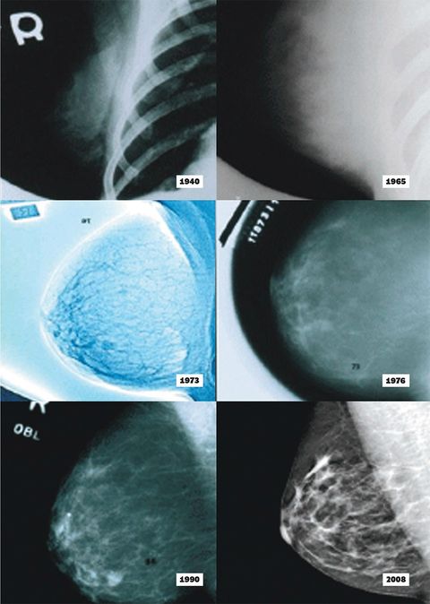 Meet The New Mammogram A 3 D Medical Breakthrough Prevention