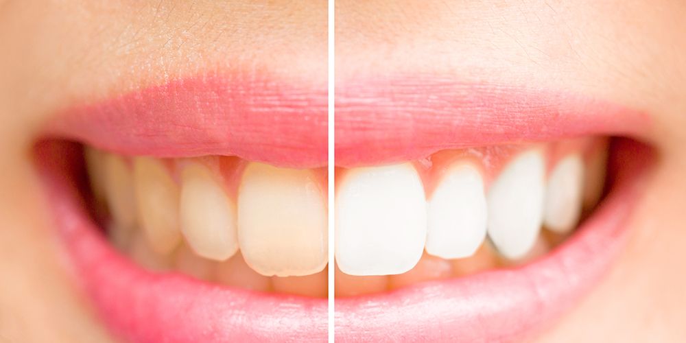 8 At-Home Teeth Whitening Products That Actually Work