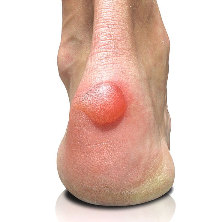 To Walk Your Way Through A Blister 