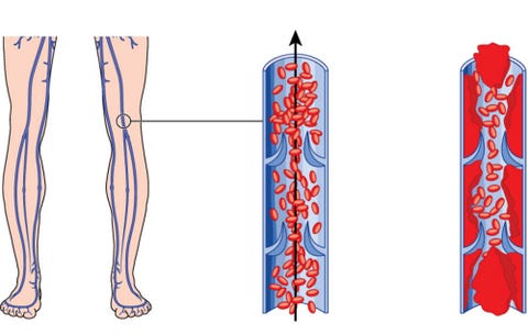 Deep vein thrombosis Deep vein thrombosis, blood clots, symptoms of a blood clot
