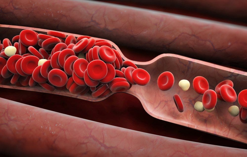 What Does a Blood Clot Feel Like? 8 Signs You Should Never Ignore