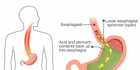 Acid reflux cause pressure in chest