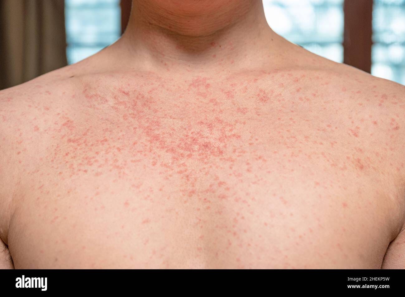 viral skin infections