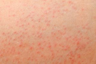 13 Common Causes For Itchy Butt Rashes And Bumps According To Mds